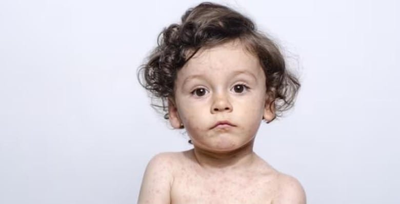 A child with measles poses for a stock photo.