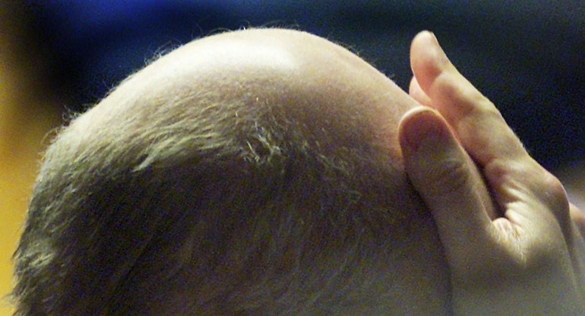 britain A closeup of a man's balding head with a hand held to the forehead.