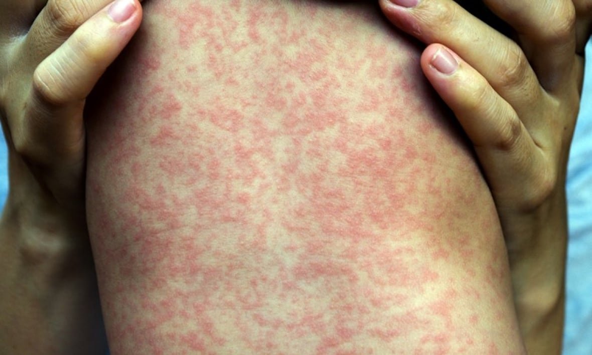 measles-rash A child's back is covered in splotchy red rashes.