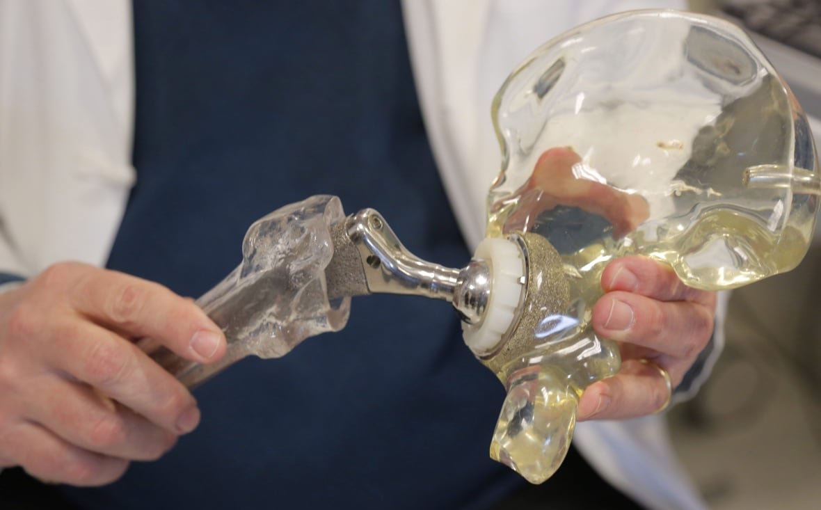A surgeon holds a model of a cementless hip replacement.